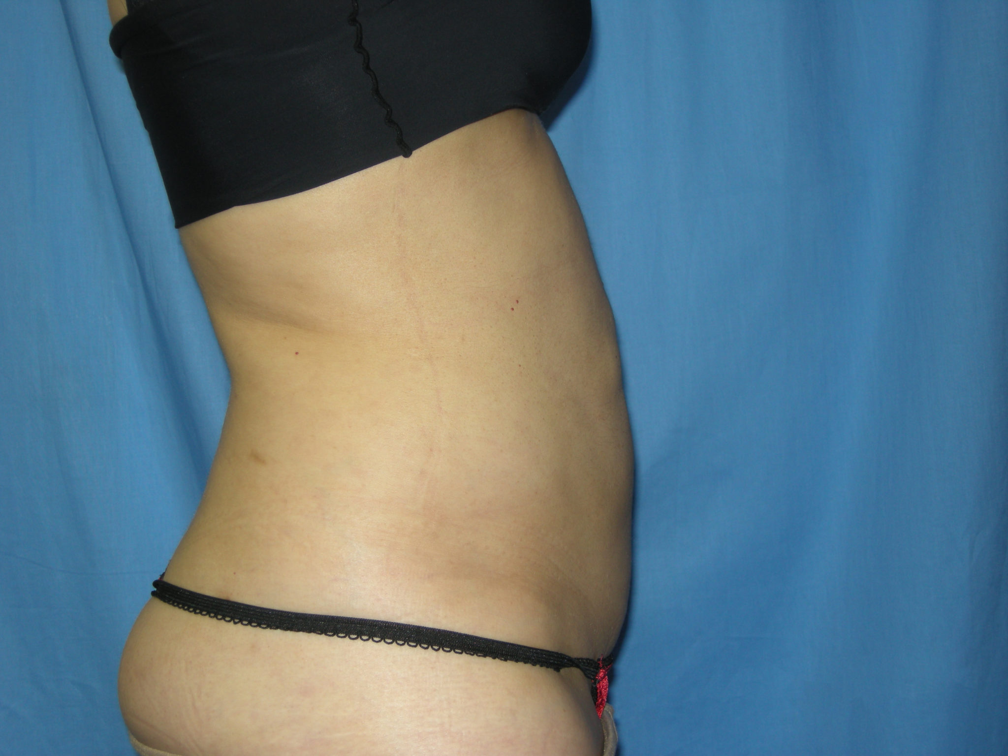 Liposuction Patient Photo - Case 3021 - after view-3