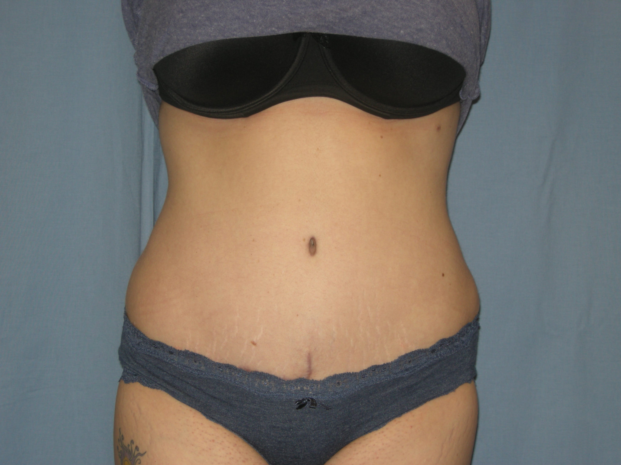 Tummy Tuck Patient Photo - Case 3332 - after view