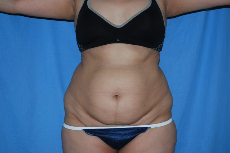 Tummy Tuck - Case 3389 - Before