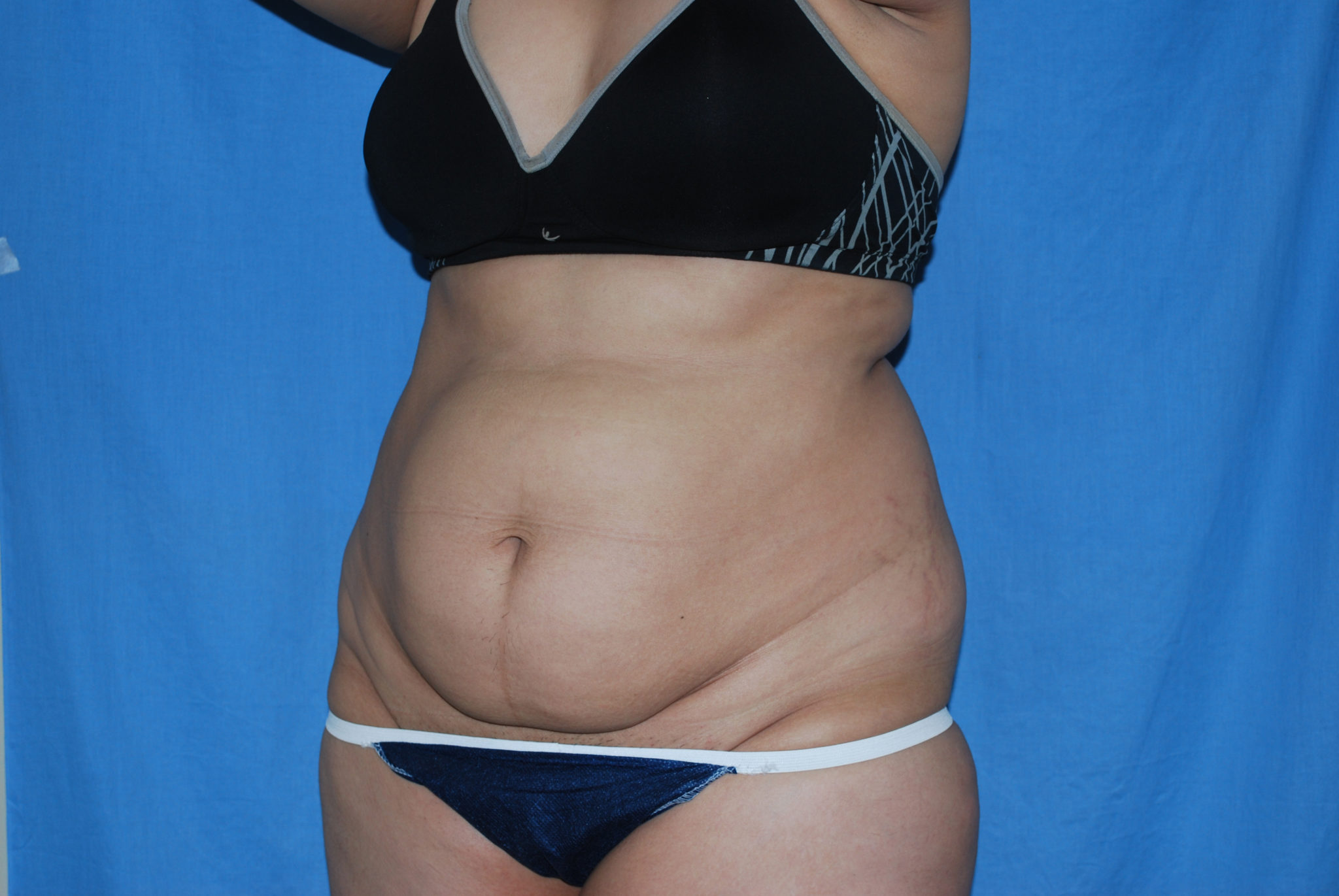 Tummy Tuck Patient Photo - Case 3389 - before view-2