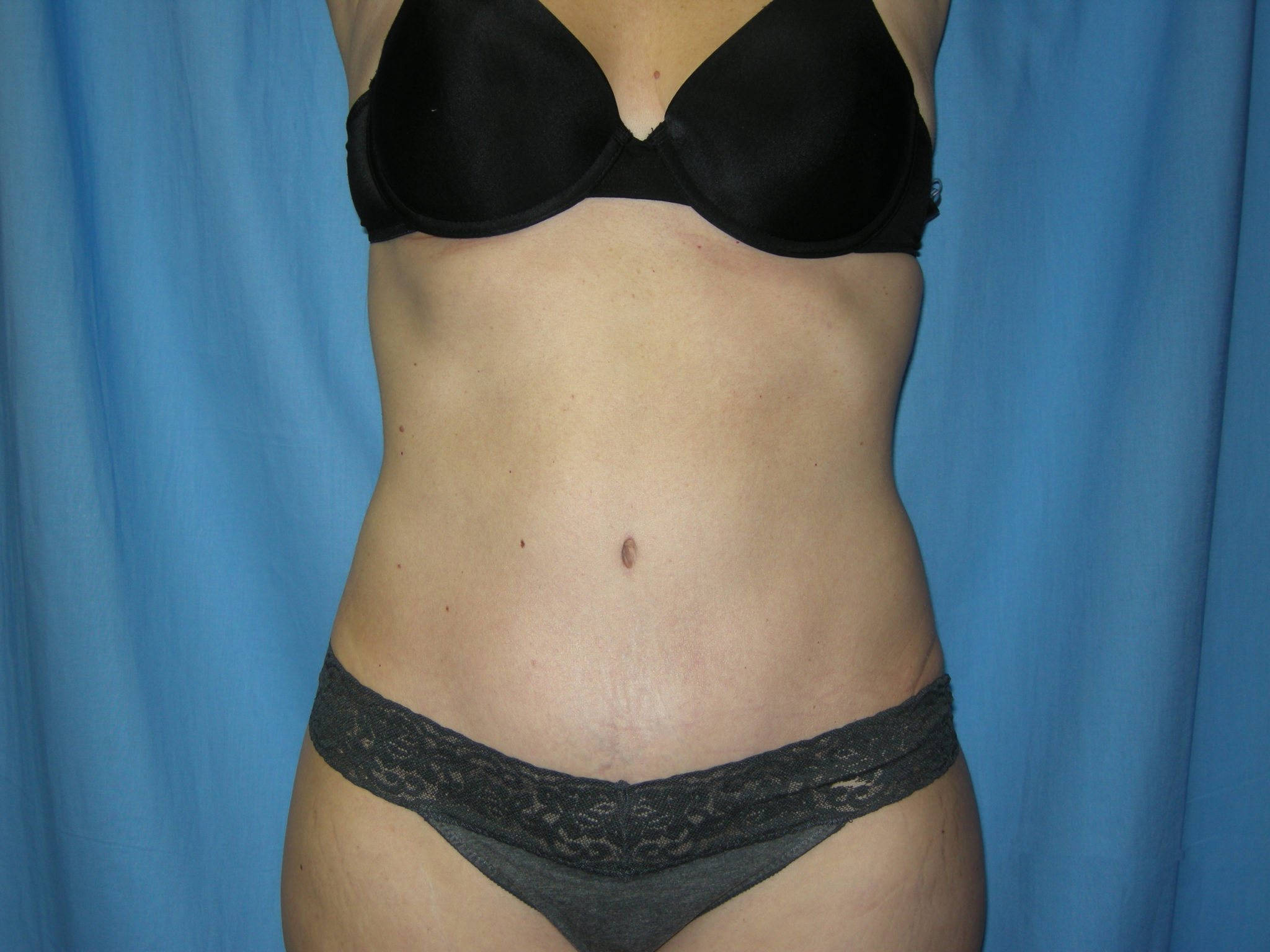 Liposuction Patient Photo - Case 3495 - after view