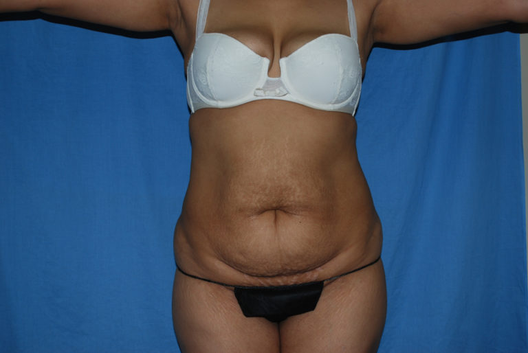 Tummy Tuck - Case 3308 - Before