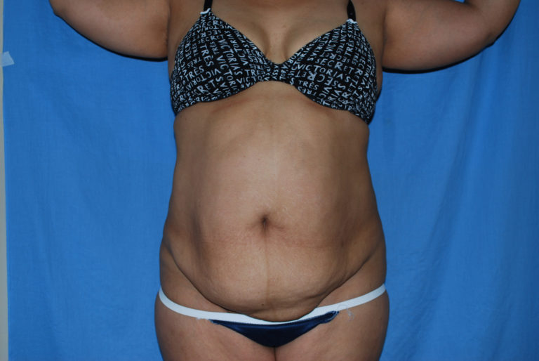 Tummy Tuck - Case 3359 - Before