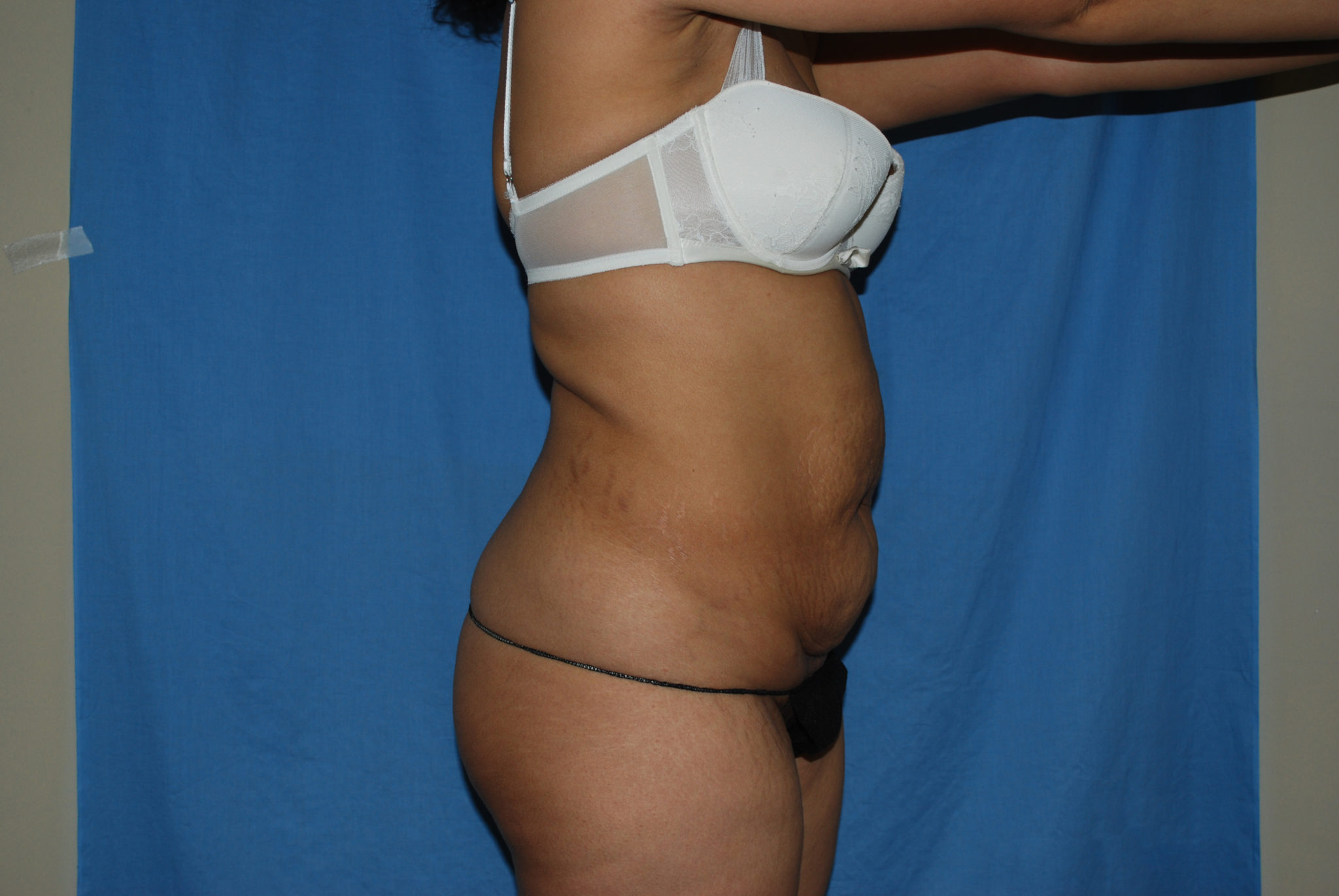 Tummy Tuck Patient Photo - Case 3308 - before view-3