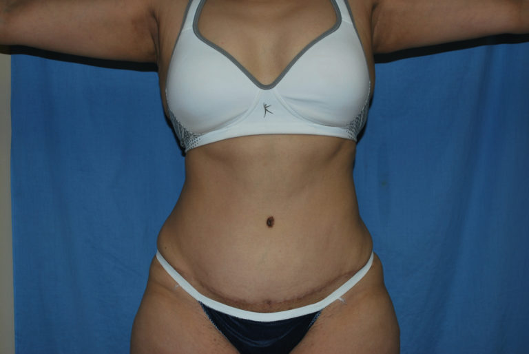 Tummy Tuck - Case 3389 - After