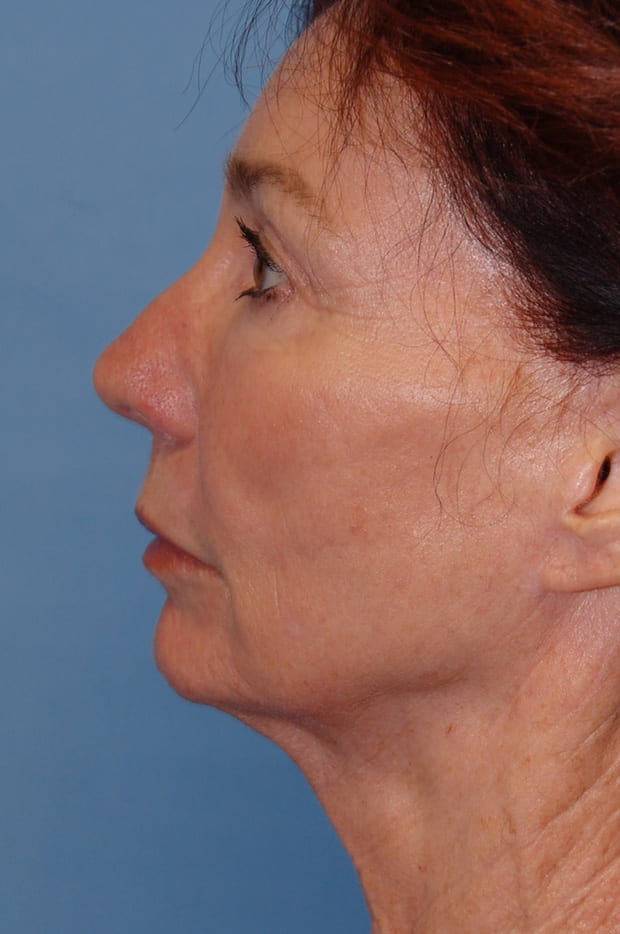 Microlift Patient Photo - Case 5098 - before view-2