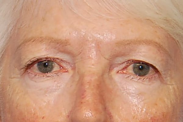 Upper Eyelid Lift - Case 5112 - Before