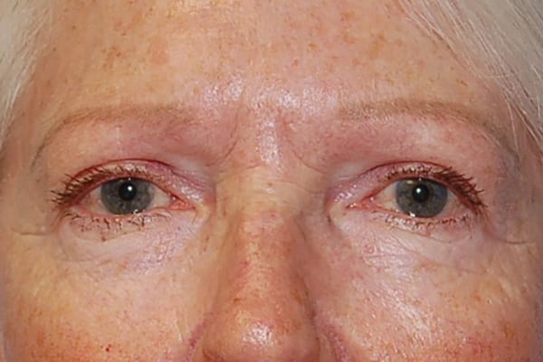 Upper Eyelid Lift - Case 5112 - After