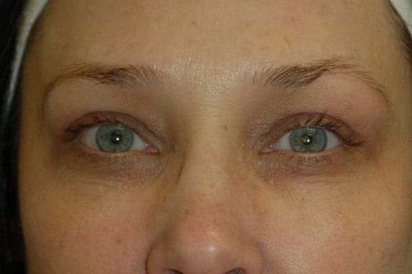 Upper Eyelid Lift Patient Photo - Case 5119 - after view