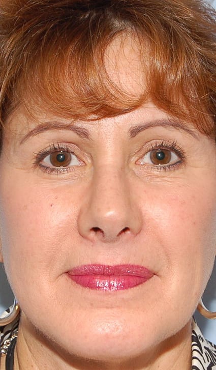 Facial Rejuvenation Patient Photo - Case 5136 - after view