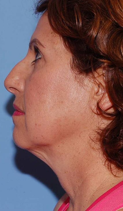 Facial Rejuvenation Patient Photo - Case 5136 - before view-2