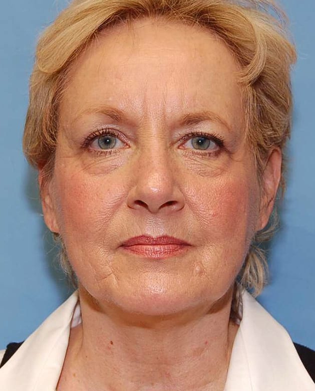 Facial Rejuvenation Patient Photo - Case 5154 - before view-