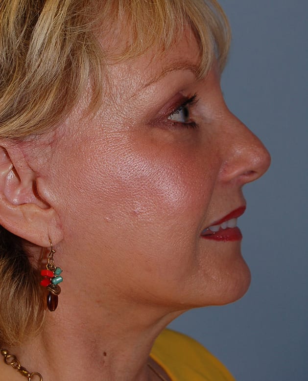 Facial Rejuvenation Patient Photo - Case 5154 - after view-4