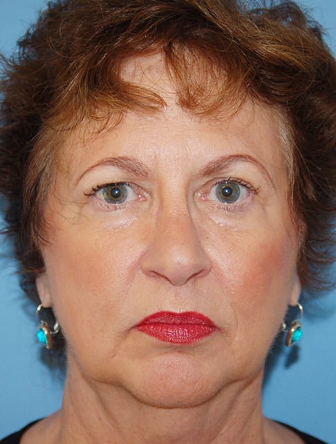 Facial Rejuvenation Patient Photo - Case 5172 - before view-