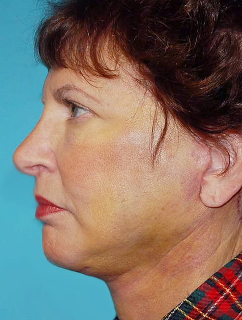 Facial Rejuvenation Patient Photo - Case 5172 - after view-2