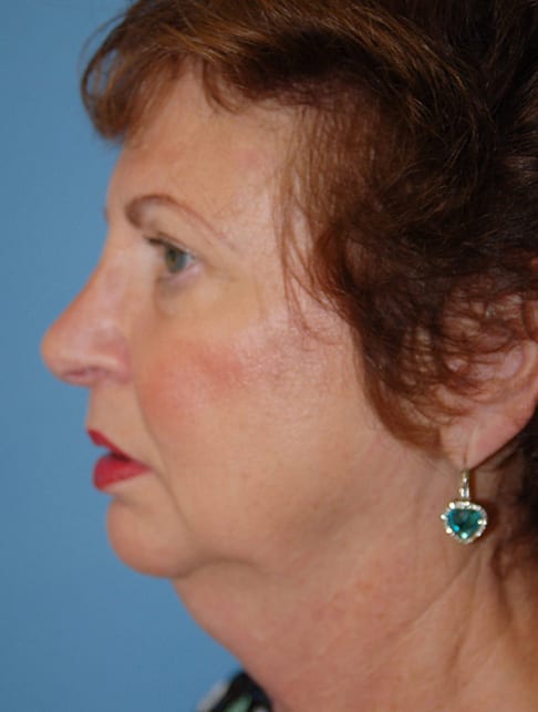 Facial Rejuvenation Patient Photo - Case 5172 - before view-2