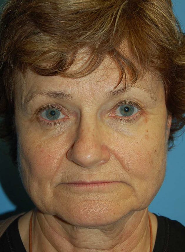 Facial Rejuvenation Patient Photo - Case 5186 - before view-