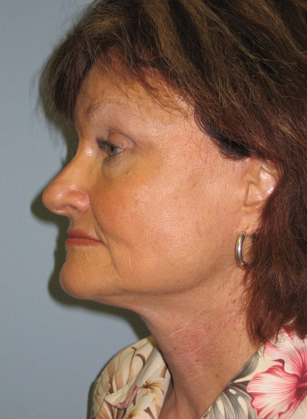 Facial Rejuvenation Patient Photo - Case 5186 - after view-2