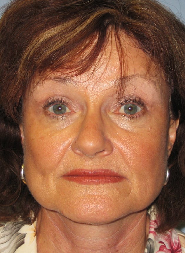 Facial Rejuvenation Patient Photo - Case 5186 - after view