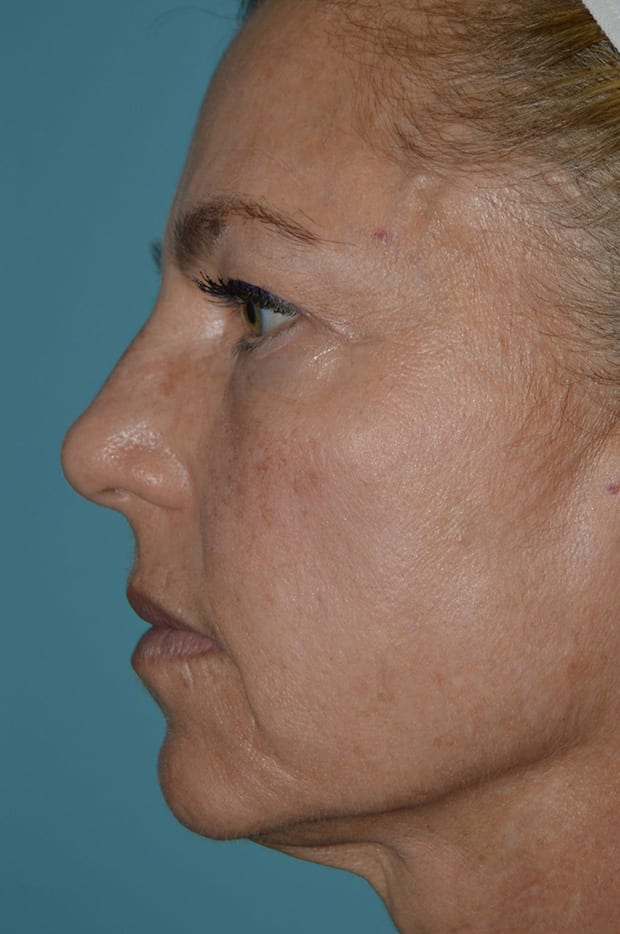 Forehead Lift Patient Photo - Case 5205 - before view-2