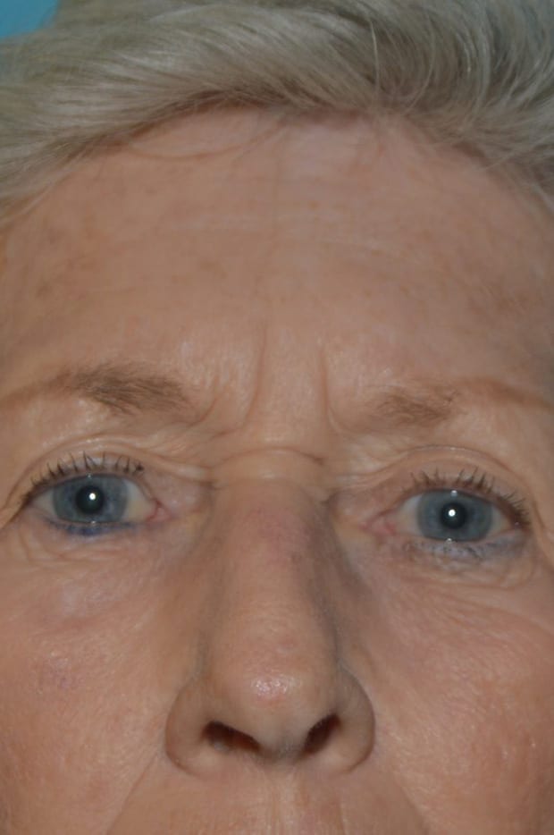 Forehead Lift Patient Photo - Case 5216 - before view-