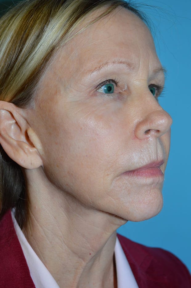 Microlift Patient Photo - Case 5230 - before view-1