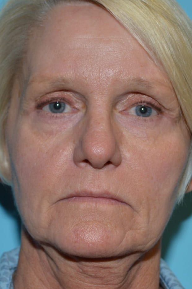 Lower Eyelid Lift/Pinch Patient Photo - Case 5239 - before view-