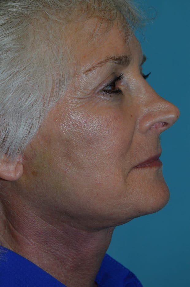 Microlift Patient Photo - Case 5263 - after view-2