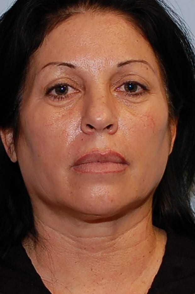 Microlift Patient Photo - Case 5283 - before view-