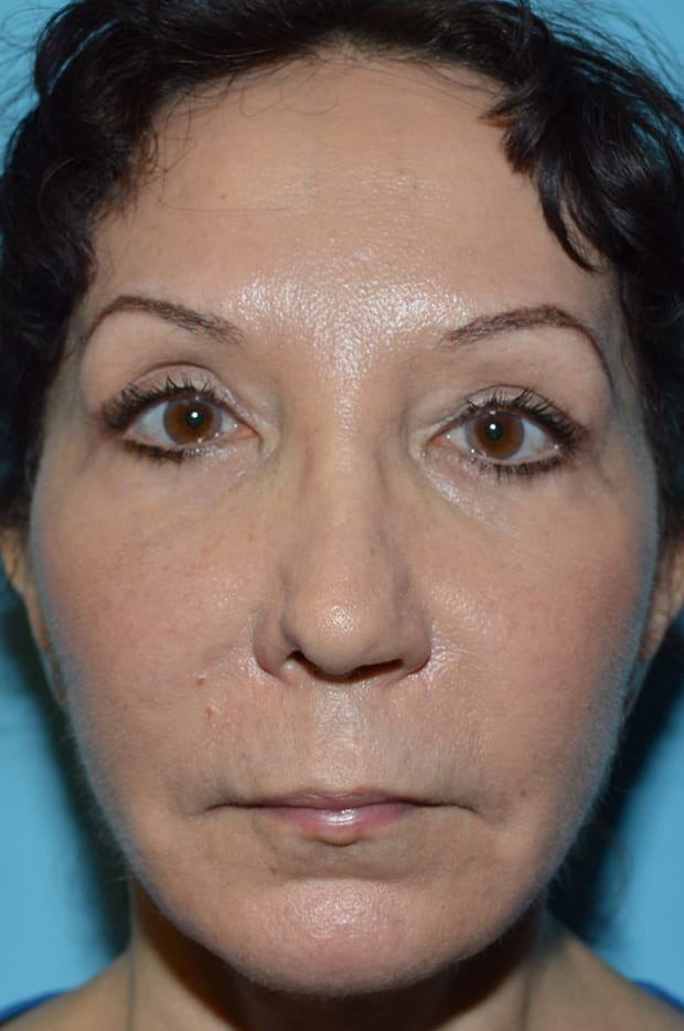 Microlift Patient Photo - Case 5302 - after view