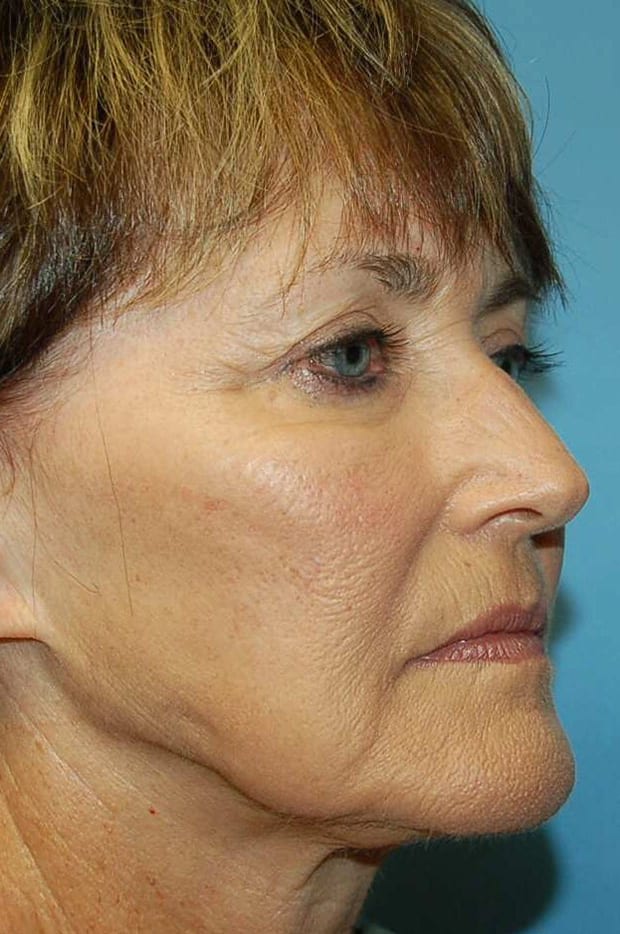 Microlift Patient Photo - Case 5327 - before view-1