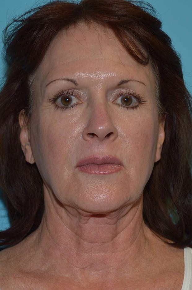 Forehead Lift Patient Photo - Case 5338 - before view-