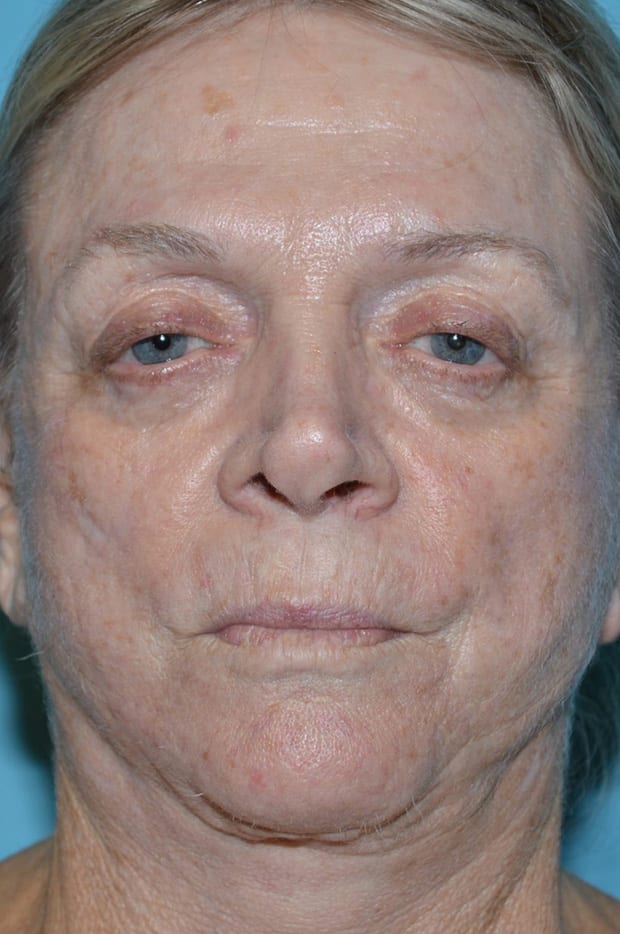 Eyelid Surgery Patient Photo - Case 5376 - before view-