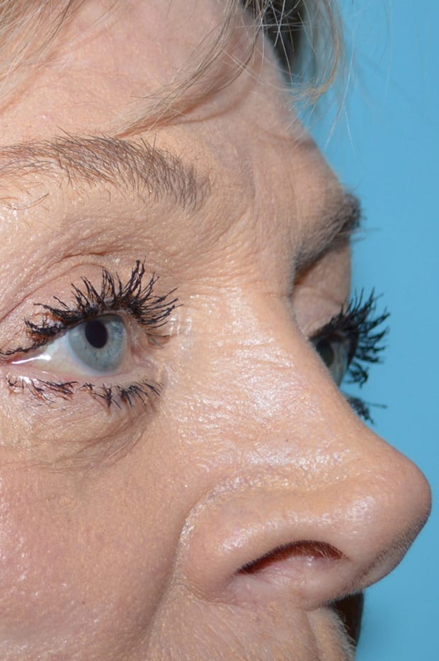 Eyelid Surgery Patient Photo - Case 5376 - after view-2