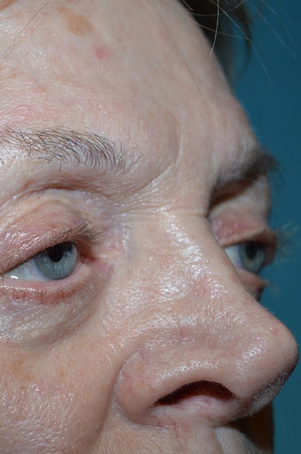 Eyelid Surgery Patient Photo - Case 5376 - before view-2