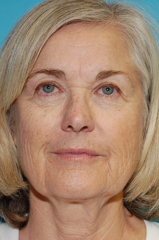 Microlift Patient Photo - Case 5387 - before view-