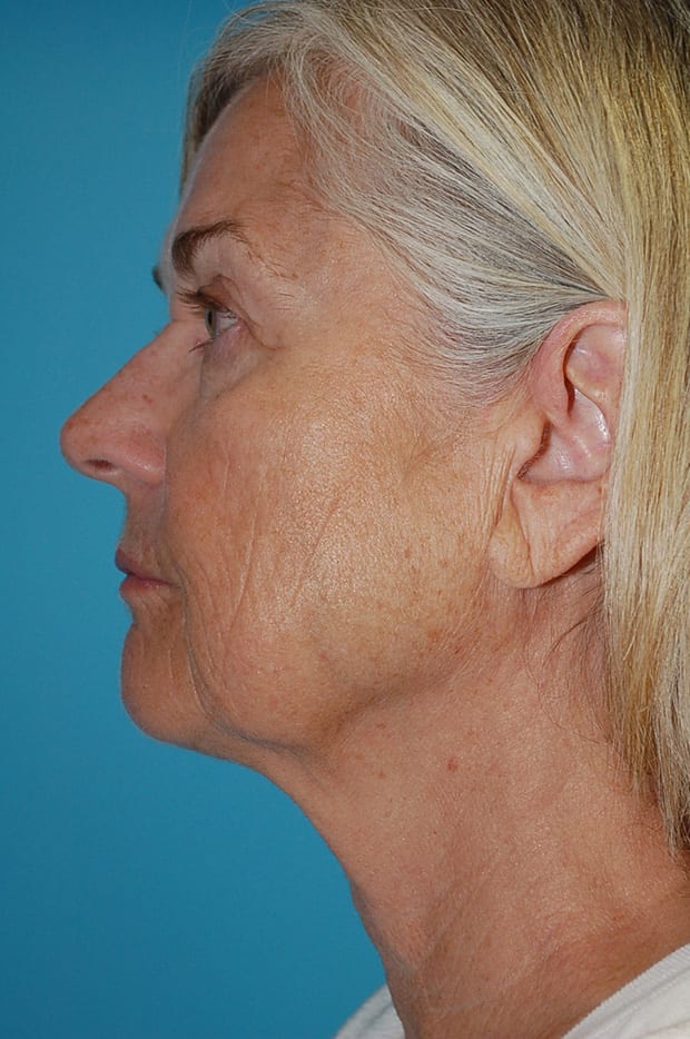 Microlift Patient Photo - Case 5387 - before view-1