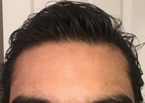 After Hair Restoration Aliso Viejo Orange County