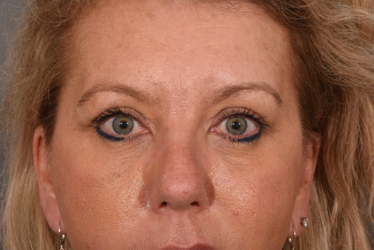 Upper Eyelid Lift - Case 5760 - After