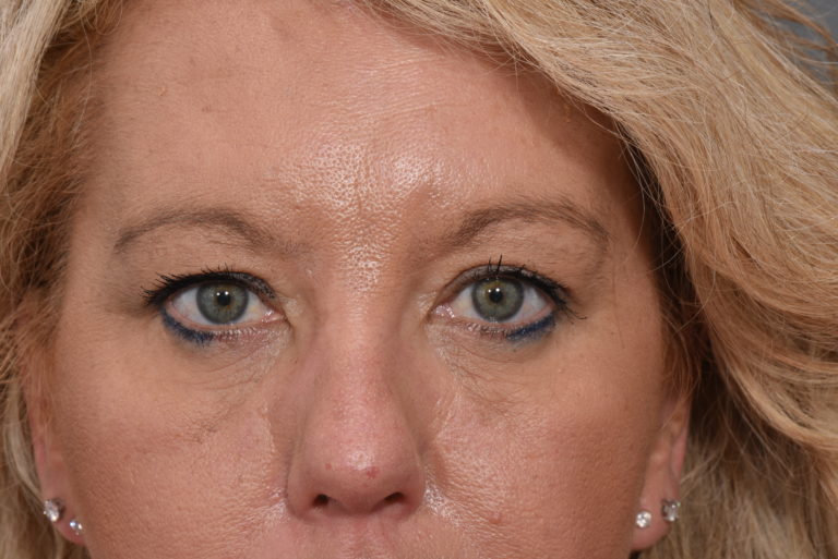 Upper Eyelid Lift - Case 5760 - Before