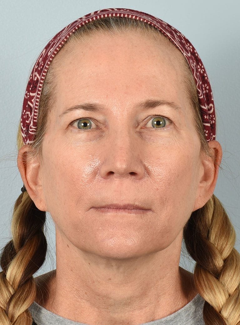 Lower Eyelid Lift/Pinch Patient Photo - Case 7371 - before view-