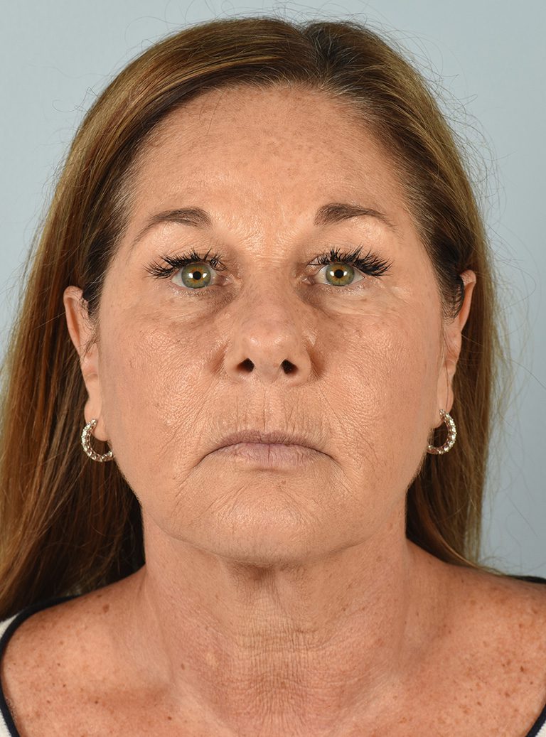 Fractional CO2 Laser - Case 8295 - Before