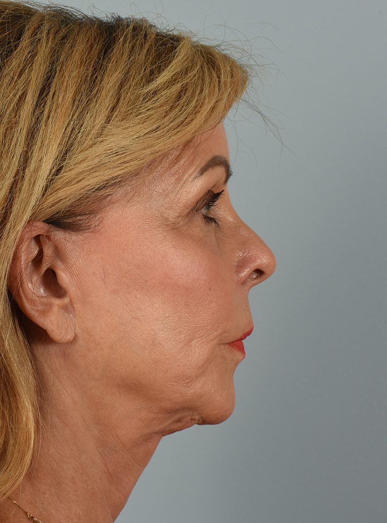 Facelift Patient Photo - Case 8306 - before view-4