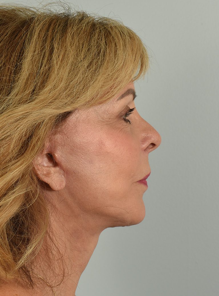 Facelift Patient Photo - Case 8306 - after view-4