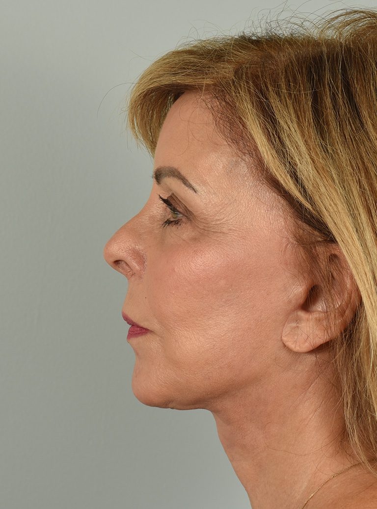 Facelift Patient Photo - Case 8306 - after view-2