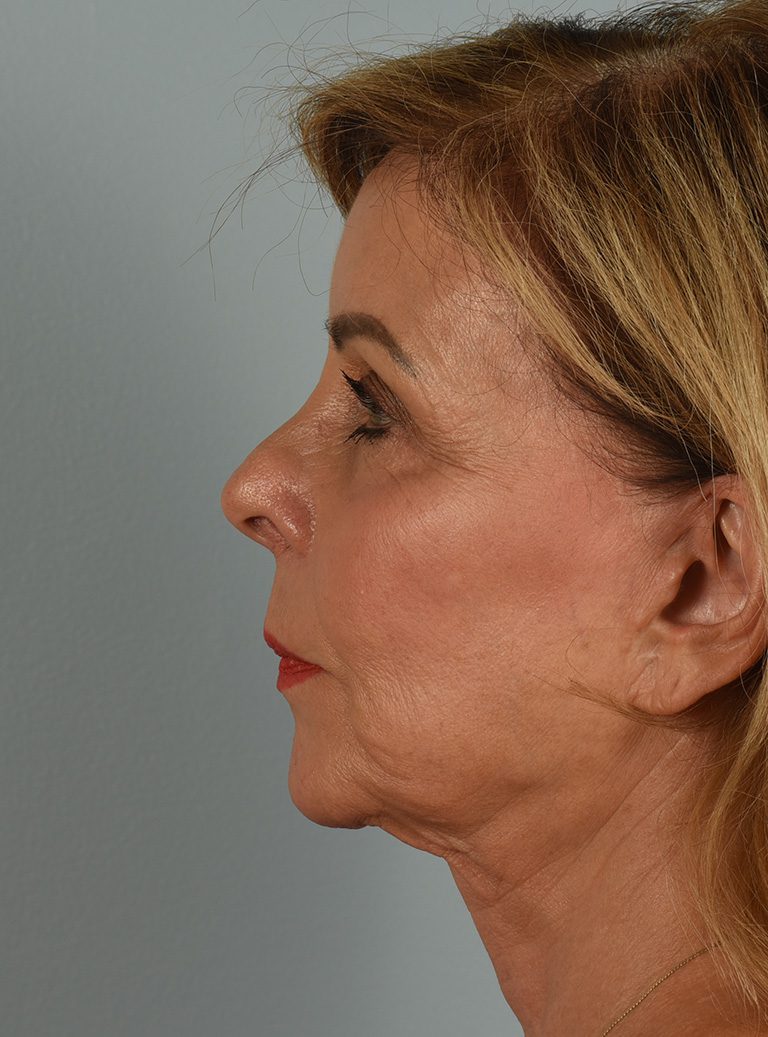 Facelift Patient Photo - Case 8306 - before view-2