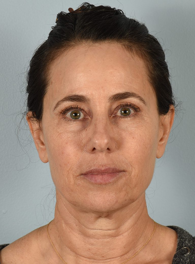 Fractional CO2 Laser - Case 8317 - Before