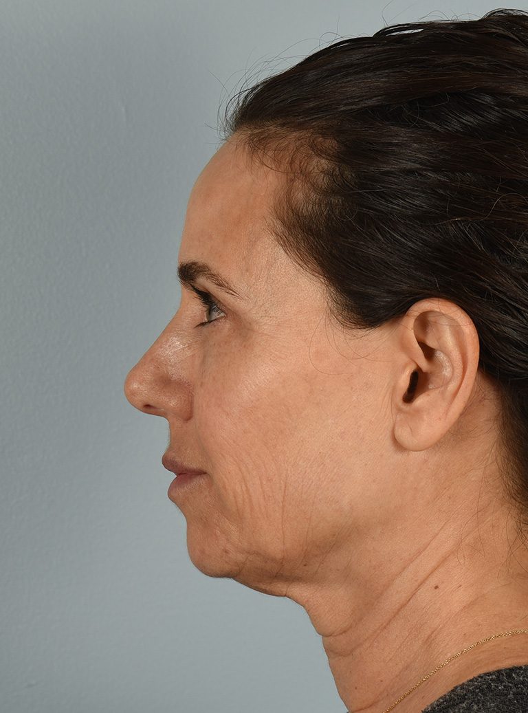 Fractional CO2 Laser Patient Photo - Case 8317 - before view-4