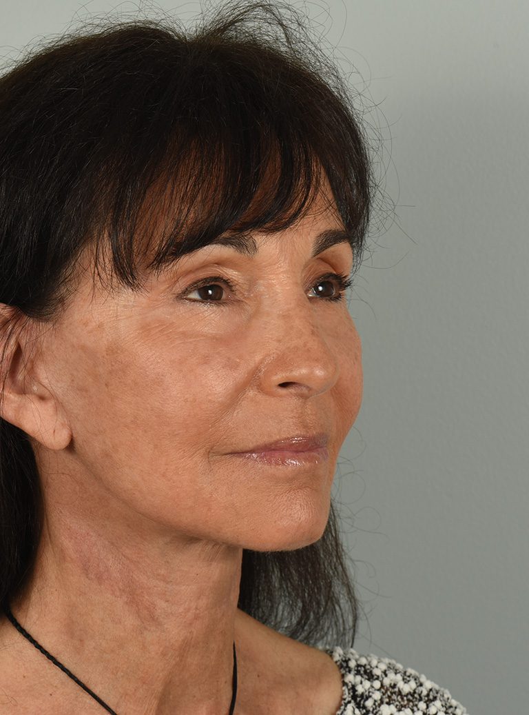 Facelift Patient Photo - Case 8328 - after view-3