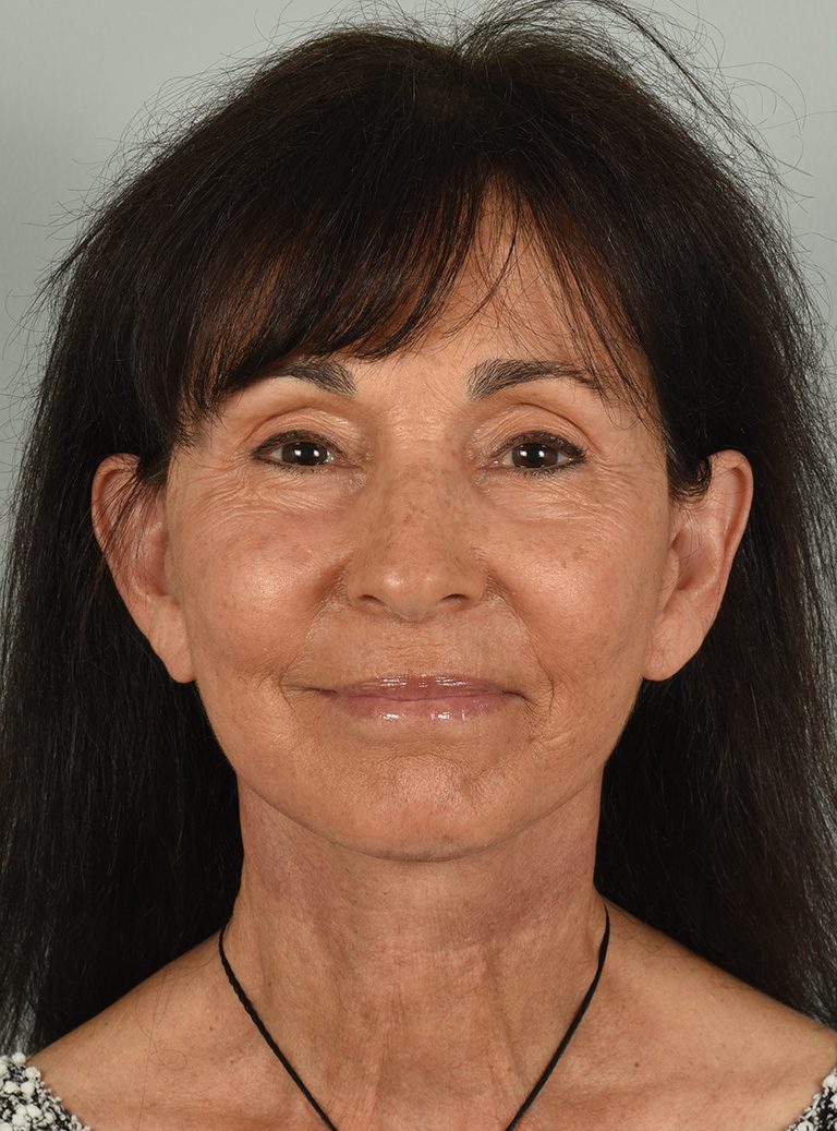 Facelift Patient Photo - Case 8328 - after view